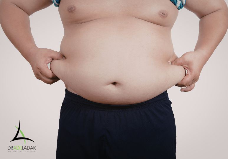 Liposuction for Men: What to Expect – Liposuction Edmonton